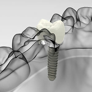 Dental_Implants