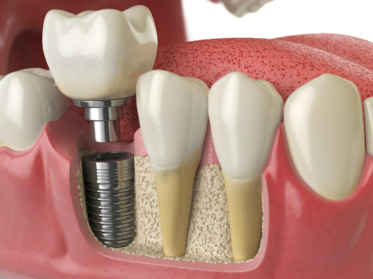 Dental Implants graphic