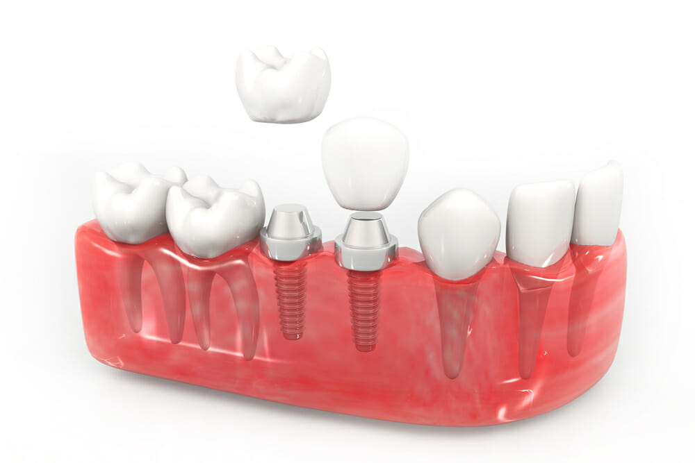 Dental Implant Post-Op Answers