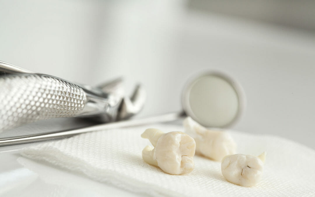What to Expect After Getting Your Wisdom Teeth Removed