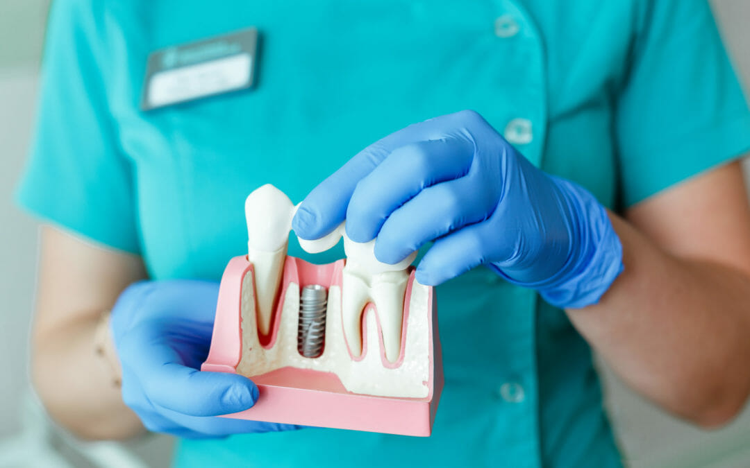 The Different Types of Dental Implants and How They Are Used