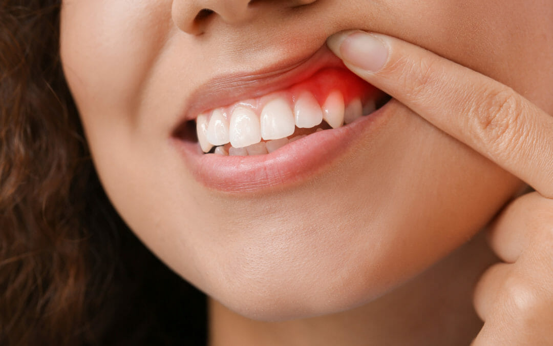 Signs That You May Have Gum Disease
