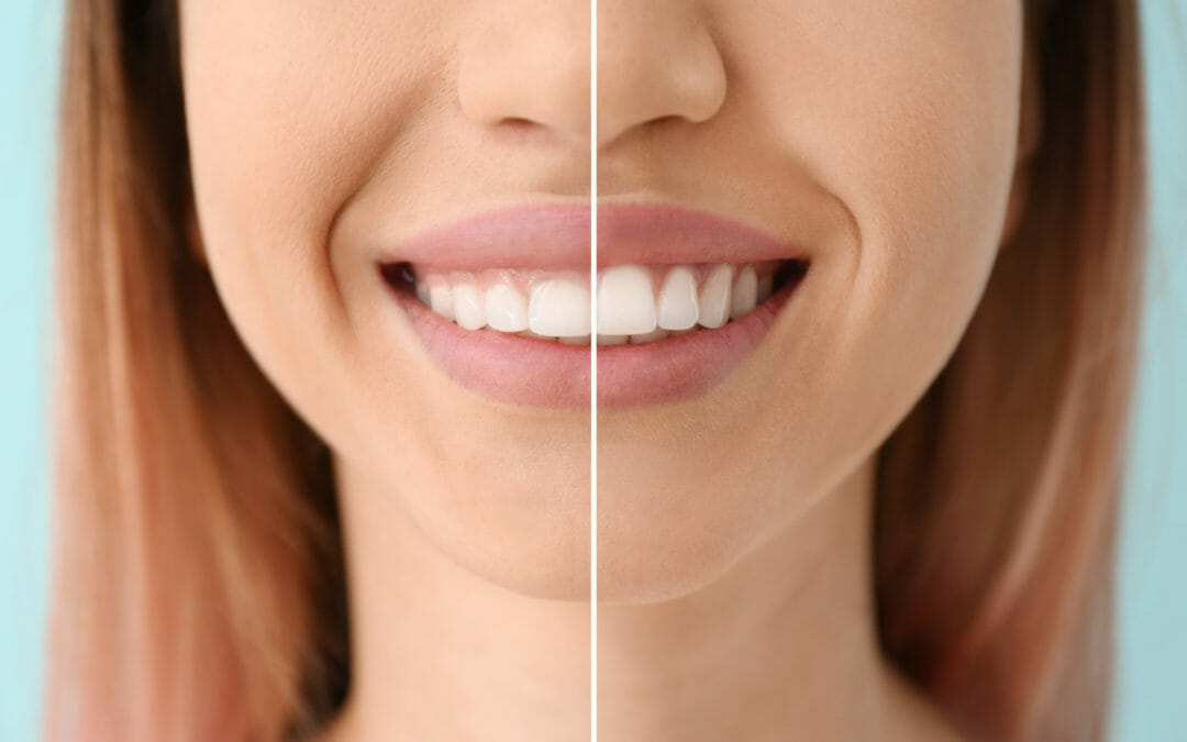 Fixing a Gummy Smile: What Can You Do?