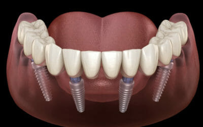 All-on-4 Dental Implants Can Transform Your Smile