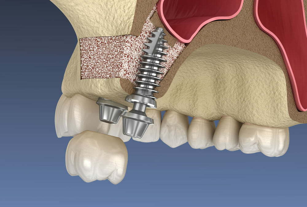 sinus lift diagram