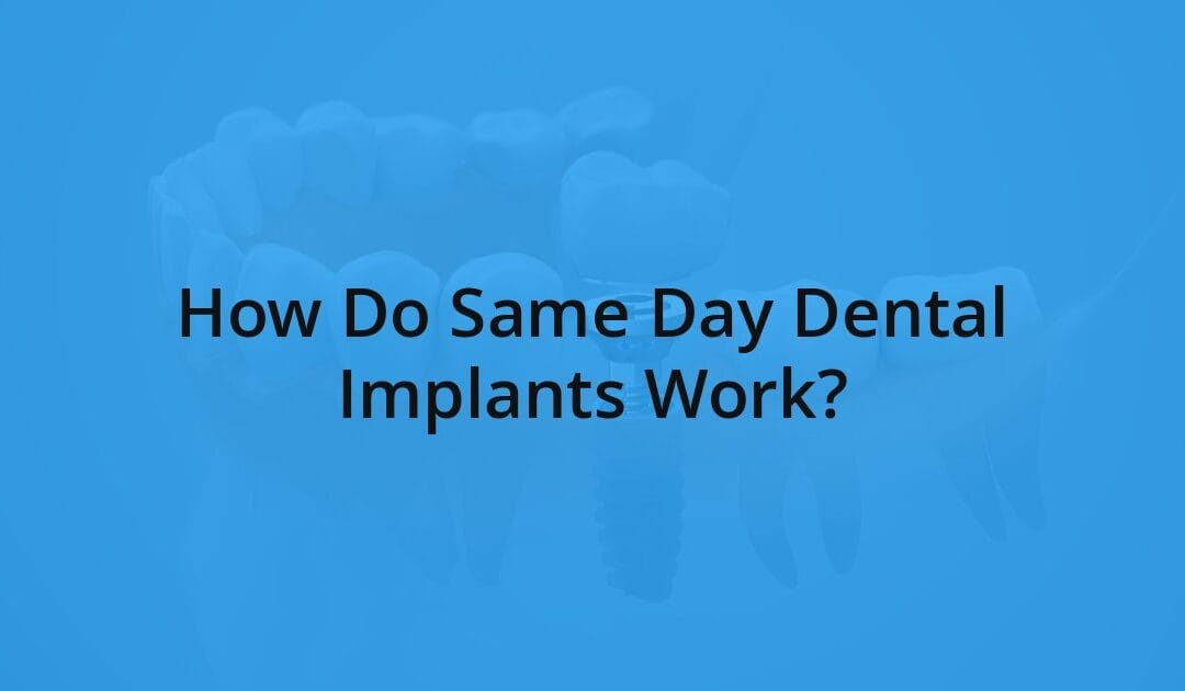 How Do Same Day Dental Implants Work? at DFW Oral Surgeons
